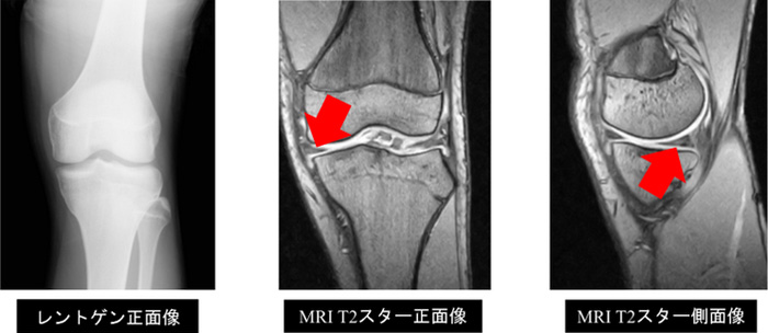 膝半月板損傷　レントゲン画像