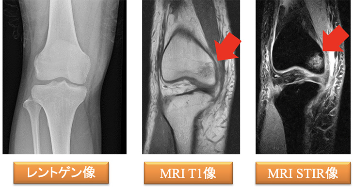 レントゲン像、MRI T1像、MRI STIR像