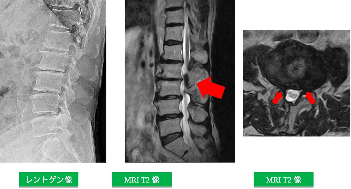 レントゲン像、MRI T1像、MRI STIR像