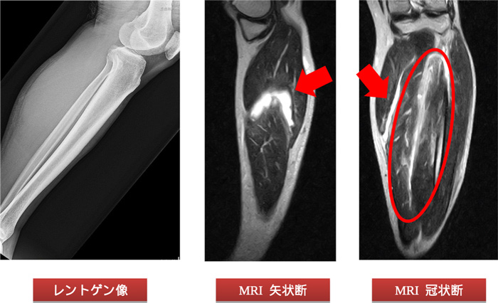 レントゲン像、MRI T1像、MRI STIR像