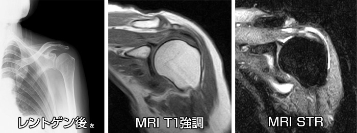 肩腱板断裂　レントゲン画像