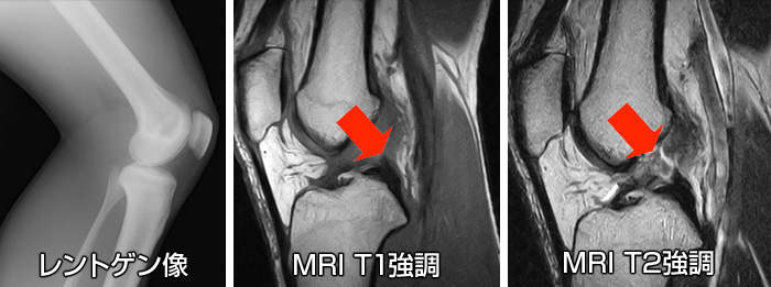 膝前十字靱帯損傷　レントゲン画像