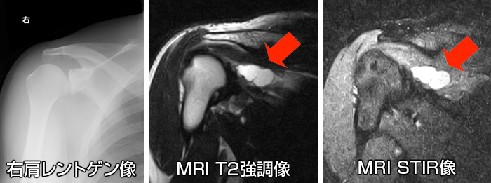 軟部腫瘍　レントゲン画像