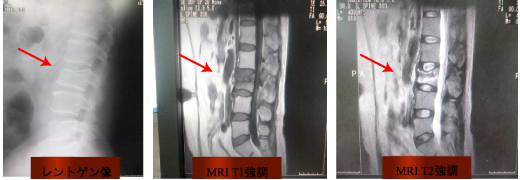 脊椎椎体骨折