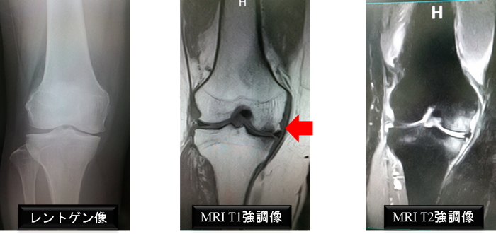 特発性膝関節骨壊死症